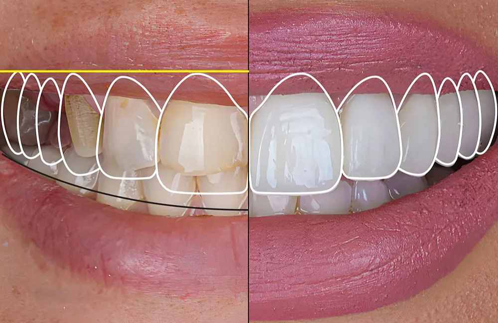 smile design